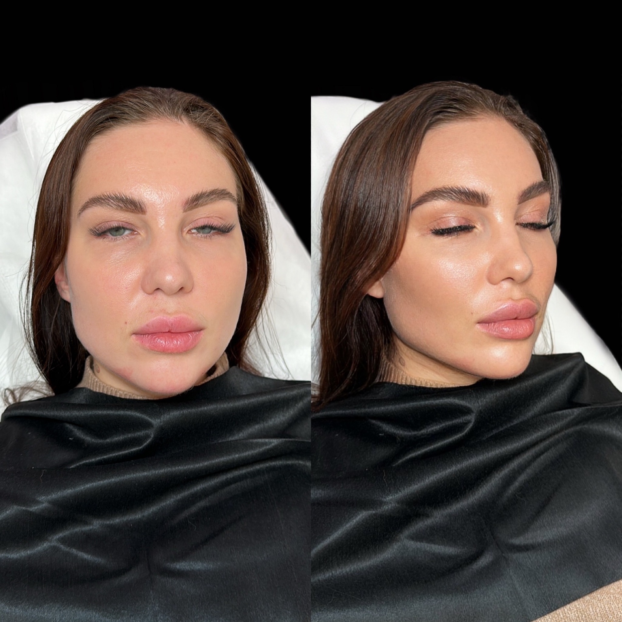 Full Face — гармонизация, сохранение мимики